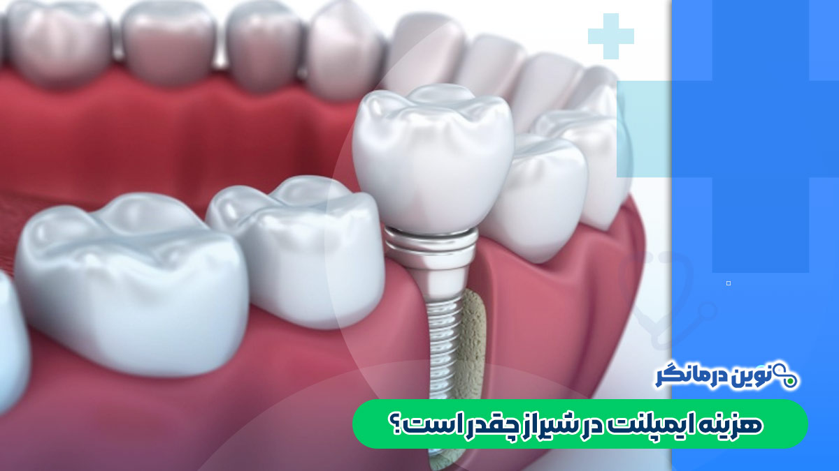 هزینه ایمپلنت در شیراز چقدر است؟