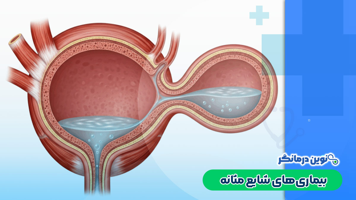 بیماریهای شایع مثانه