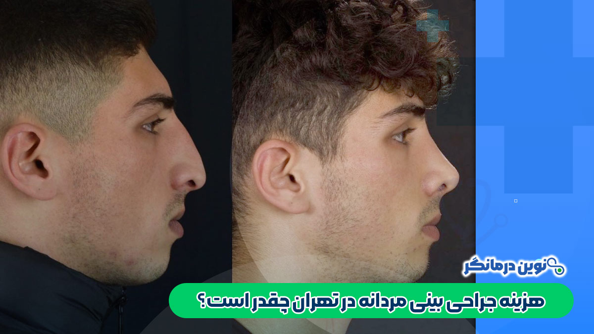 هزینه جراحی بینی مردانه در تهران چقدر است؟