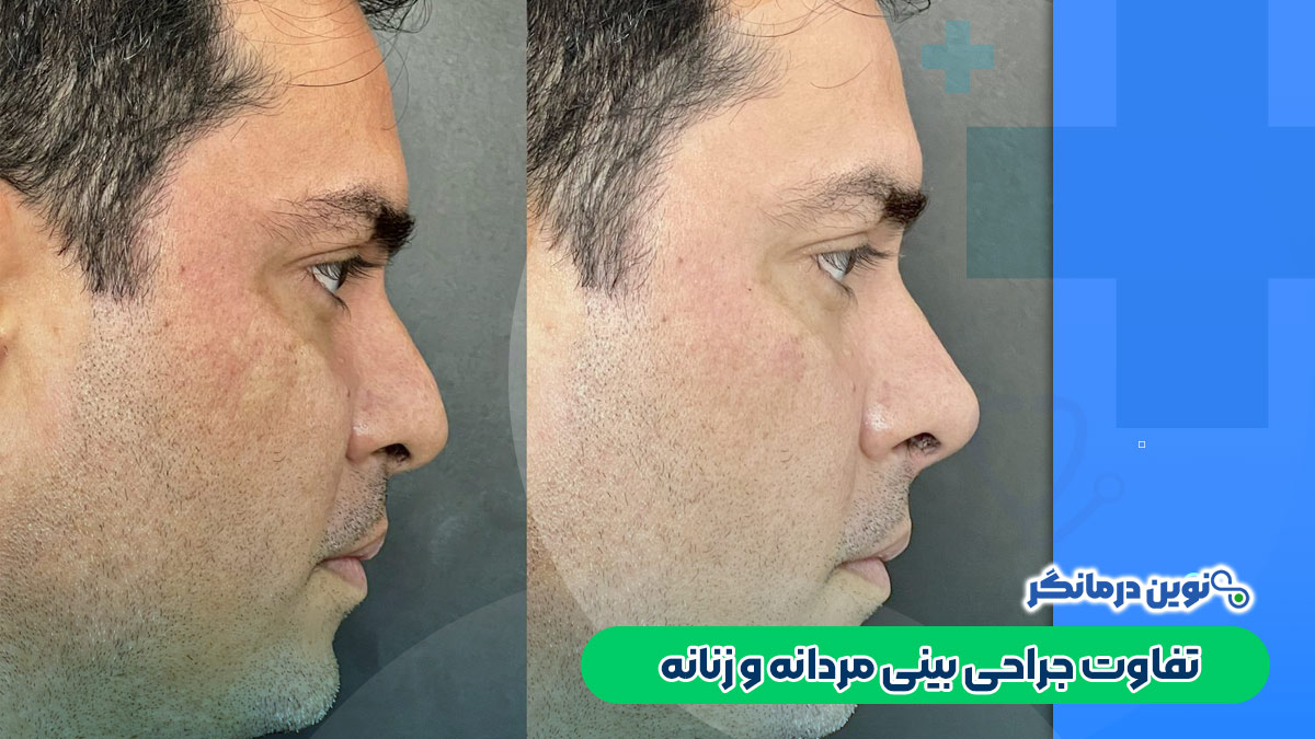تفاوت جراحی بینی مردانه و زنانه