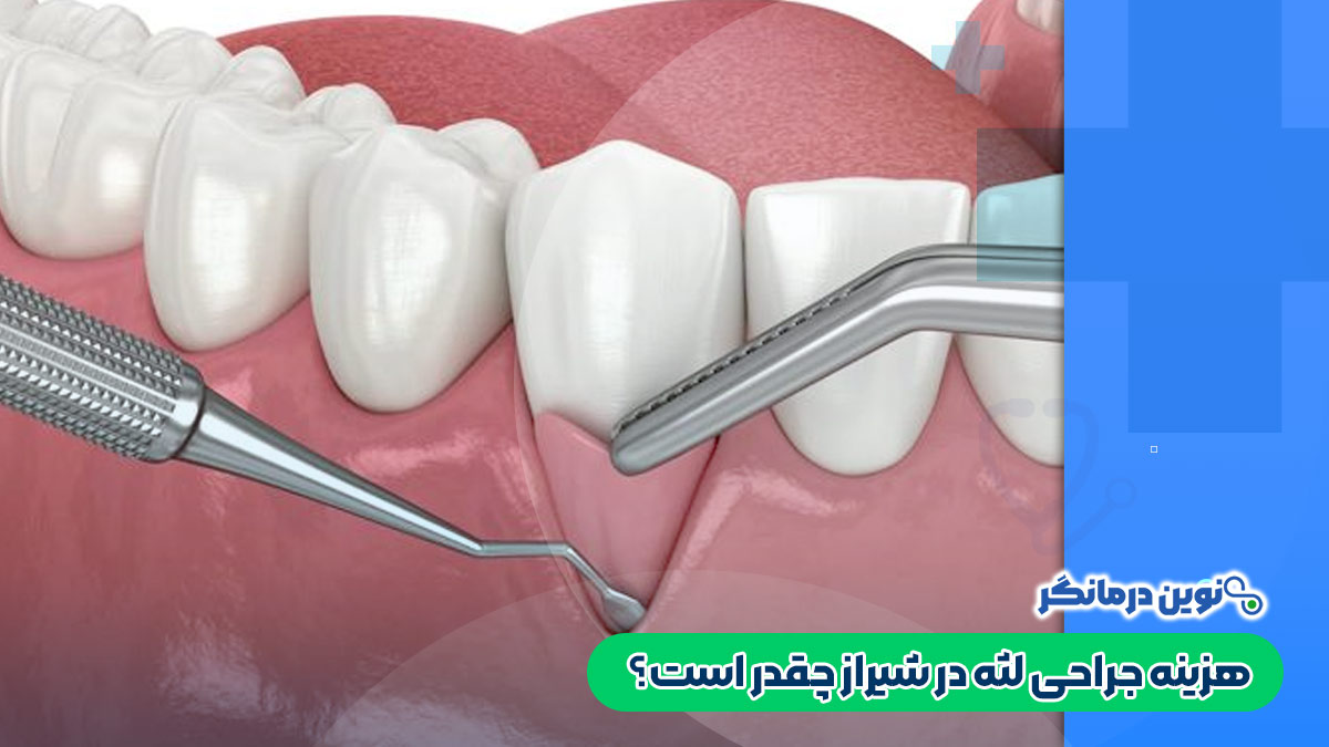 هزینه جراحی لثه در شیراز چقدر است؟