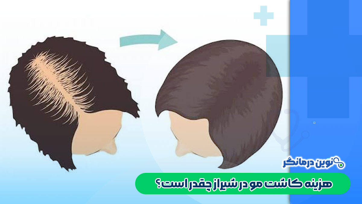 هزینه کاشت مو در شیراز چقدر است؟