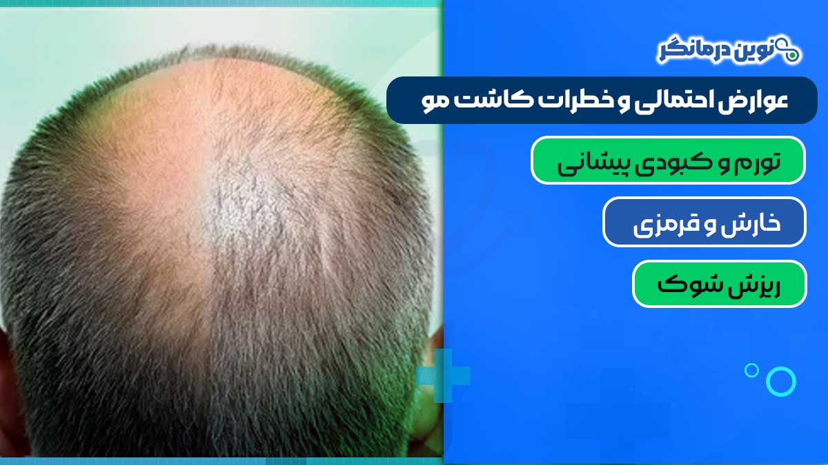 عوارض احتمالی و خطرات کاشت مو