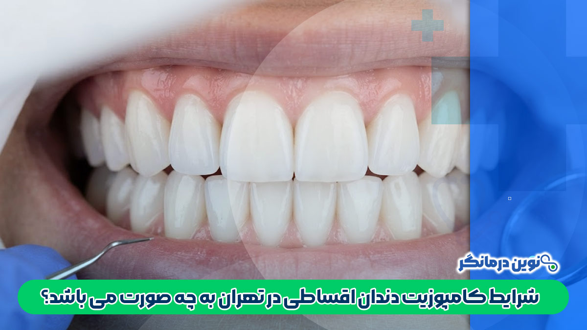 شرایط کامپوزیت دندان اقساطی در تهران به چه صورت می باشد؟