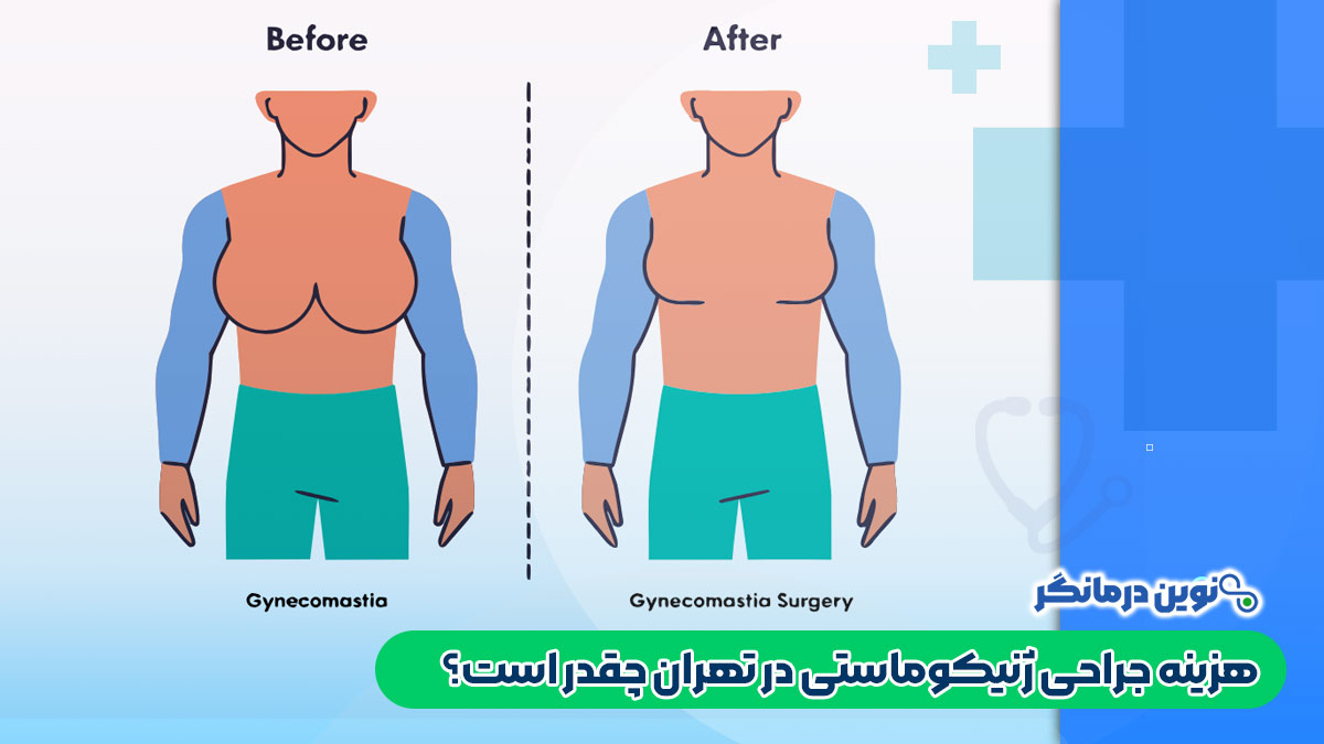 هزینه جراحی ژنیکوماستی در تهران چقدر است؟