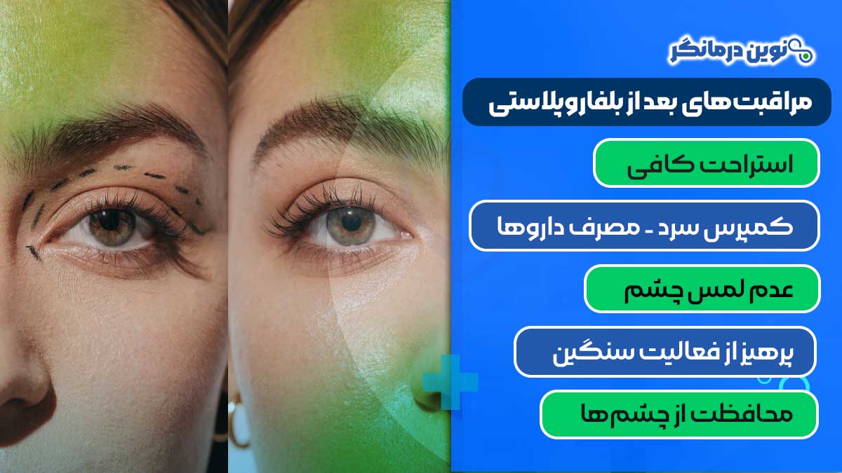 مراقبتهای بعد از بلفاروپلاستی