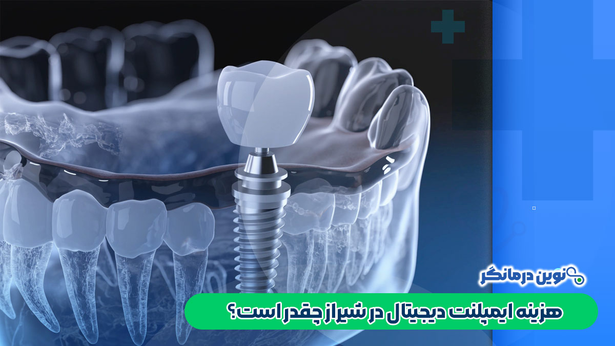 هزینه ایمپلنت دیجیتال در شیراز چقدر است؟