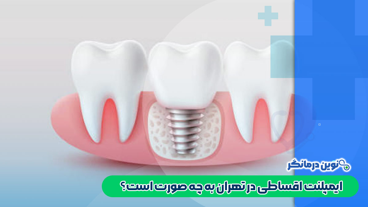 ایمپلنت اقساطی در تهران به چه صورت است؟